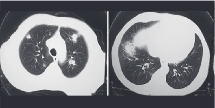 FIGURE 1 -  Chest computed tomography: pulmonary iniltrates scattered  throughout the parenchyma of both lungs evidenced in probable cases of  invasive aspergillosis