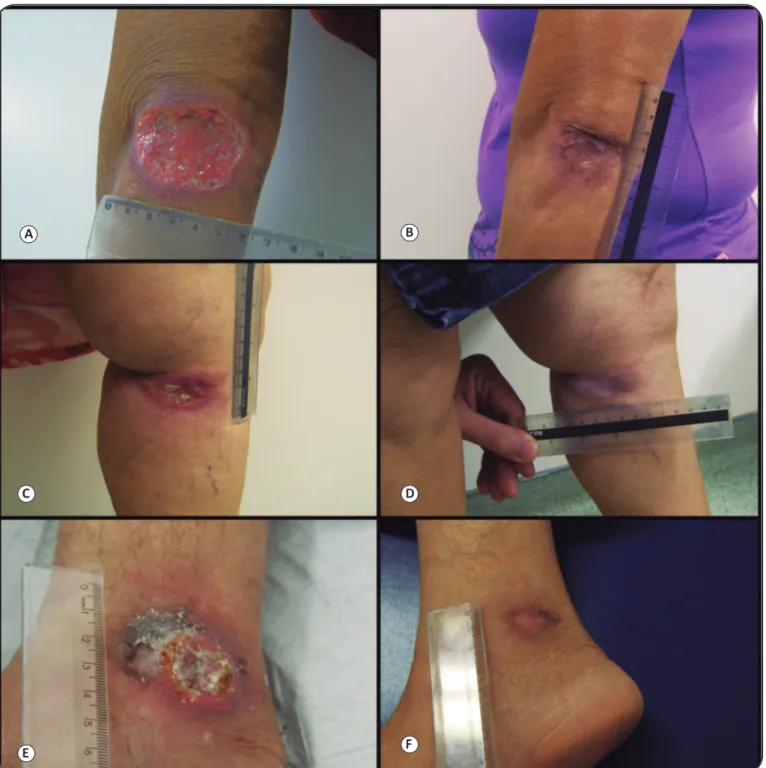 FIGURE 1 - Cutaneous leishmaniasis with large periarticular lesions in three patients treated with intralesional meglumine antimoniate, before and after  therapy