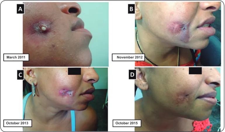 FIGURE 1. Five-year follow-up of botryomycosis-like pyoderma on the right malar region of a 28-year-old HIV-infected woman between 2011 and 2015