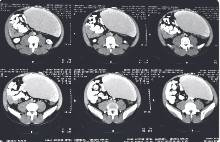 FIGURE 2. Computerized axial tomography showing the huge spleen in the iliac fossae. The patient’s lymphocytopenia could be related  to the storage of blood cells in this organ.