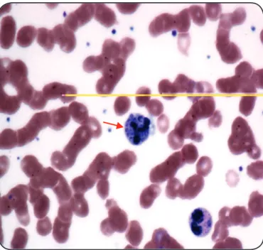 FIGURE 1 - Peripheral blood smear - multiple yeasts in neutrophil (arrow). 