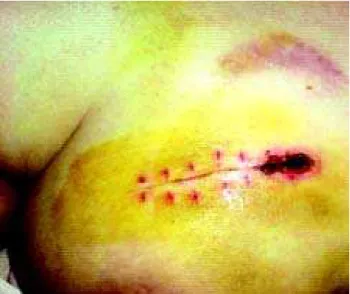 Figure 3 - Slow chemical debridement
