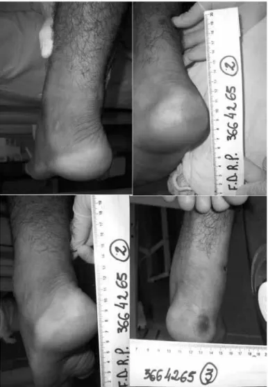 Figure 1 - Evolution of the calcaneus region of a critical patient  evaluated by digital photographs and the Braden Scale on the 1st,  5th, 10th and 15th day - Fortaleza, Brazil, 2010