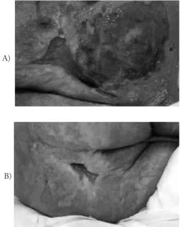 Figure 1 – Initial assessment of the PU (a) and evaluation on day  15 of follow-up (b) – Porto Alegre, Brazil, 2014.