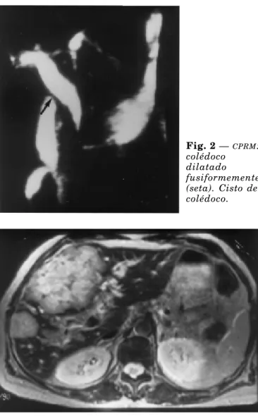 Fig. 3A —  CPRM : dilatação das vias biliares intra- intra-hepáticas com um efeito de massa na junção dos ductos hepáticos.