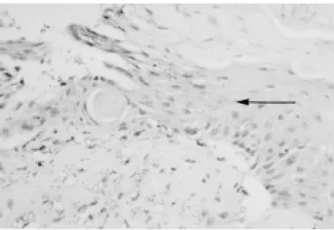Fig. 2 – Hind footpad  – epidermal keratinocytes mito- mito-chondria crystolysis (→). Esperimental cutaneous  leish-maniasis, C57Bl/6j inbred mice, inoculation of 10 7 L