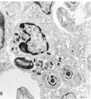 Fig. 3 – Hind footpad  – Leishmania amastigote forms (→) inside eosinophil (E). Experimental cutaneous  leisma-niasis, C57BL/6j inbred mice, inoculation of 10 7 L