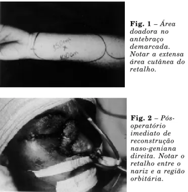 Fig. 1 – Área doadora no antebraço demarcada. Notar a extensa área cutânea do retalho.