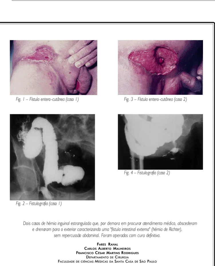 Fig. 1 – Fístula entero-cutânea (caso 1) Fig. 3 – Fístula entero-cutânea (caso 2)