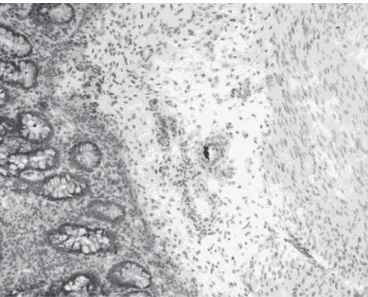 Figura  2 – Criança com aganglionose congênita. Observar fibrilas e troncos nervosos de coloração ocre, correspondentes a aumento da atividade de acetilcolinesterase