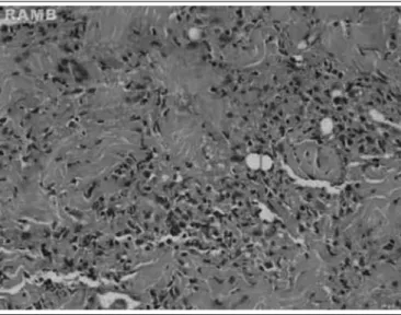 Figura 3 - Iniltrado de células mononucleares de tamanho  intermédio/grande com núcleos irregulares, paquicromáticos