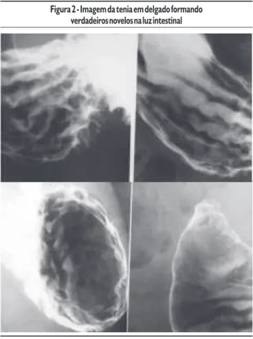 Figura 1 - A seta demonstra a presença do verme na luz do intestino delgado formando filetes escuros em meio ao contraste