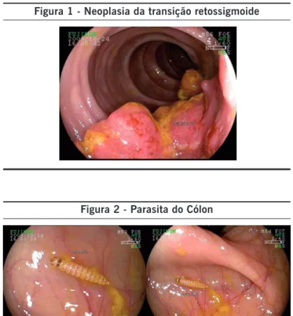 Figura 1 - Neoplasia da transição retossigmoide
