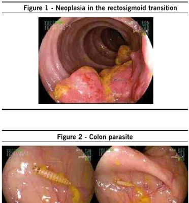Figure 1 - Neoplasia in the rectosigmoid transition