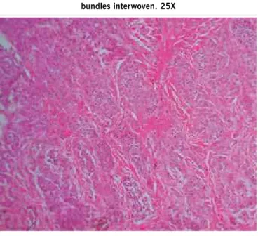 Figure 3 - Presence of nests of irregularly pigmented nevocytes,  arranged in the reticular dermis 