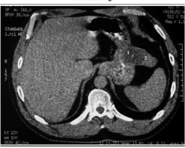 Figura 1 - Tomograia computadorizada de abdome com contraste  evidenciando lesão hipodensa causando abaulamento para 