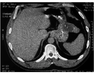 Figure 1 – Contrast-enhanced abdominal CT, showing a hypodense  lesion extending into the stomach lumen