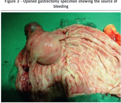 Figure 2 - Subtotal (central) gastrectomy specimen showing  neoplastic lesion