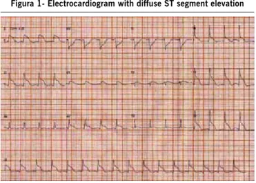 Figura 1- Electrocardiogram with diffuse ST segment elevation