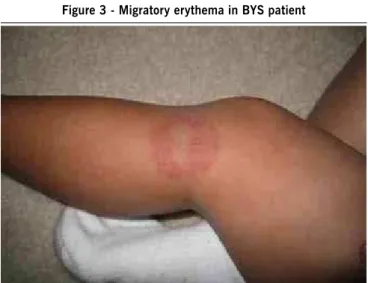 Figure 3 - Migratory erythema in BYS patient