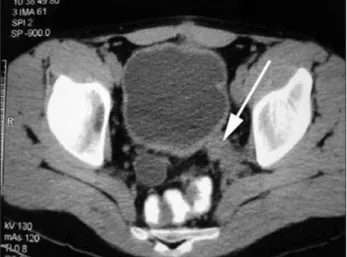 Figure 3 – CT imaging showing reduction of the retroperito- retroperito-neal mass (arrow) after 12 months of clinical therapy.