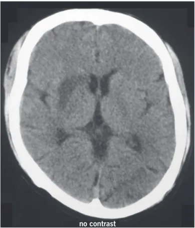 Figure 2 – Axial FLAIR weighted MRI shows multiple areas  of ischemia, affecting the territory of small vessels in the  cortical, subcortical and basal ganglia area.