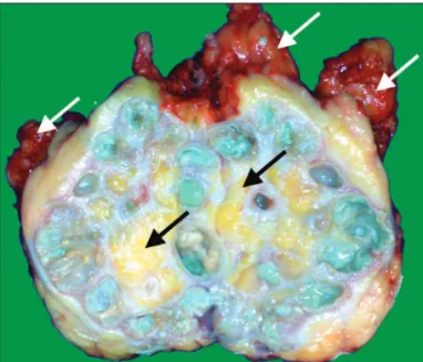 Figure 3 – On cut-surface, the specimen showed an irregular,  friable, green/yellow mass replacing the entire renal  paren-chyma, with a pale and shiny mucosa illed with ine  granu-lar calculi