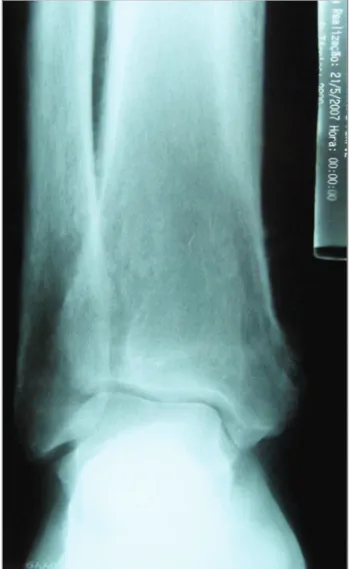 Figure 3 – Thickening of cortical layers in x-ray of tibia.