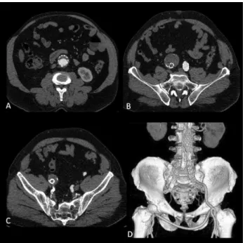 Figure 1 – Axial MDCT images showing a semi- semi-circumferential thrombus on the anterior internal wall  of aortic endoprosthesis (A); right common iliac artery  aneurysm associated with occlusion of the endoprosthesis  and presence of an occluder in the 
