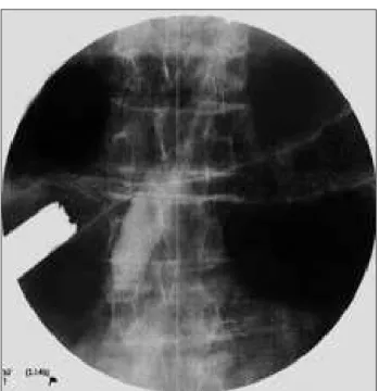 Figure 2 –Radiologic image immediately after the passage  of prosthesis under fluoroscopy