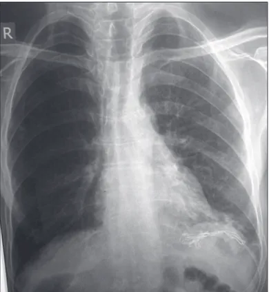 Figure 1 – Radiography showing radiopaque shadow of a  probable foreign body under the left hemidiaphragm.