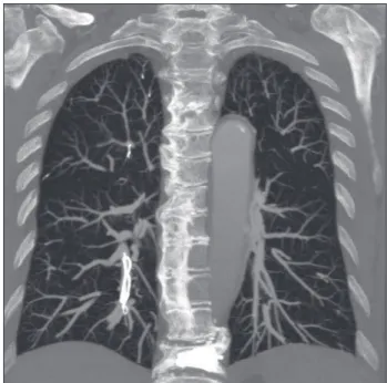 Figure 1 – Thorax computed angiotomography showing dense  intravascular masses.