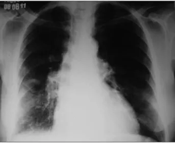 Figure 2 – Complete radiological resolution after seven days  of treatment for congestive heart failure