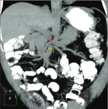 Figure 3 – Intersection of the superior mesenteric artery in  front of the vein, at the right of it.