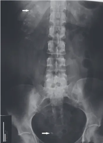 Figure 1 – Abdominal X-ray of the patient showing clustered  calcifications in projection of the kidneys, more evident at  the right side (upper arrow identifies one of these clusters)