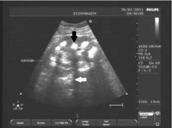 Figure 2 – Ultrasonographic appearance of patient’s right  kidney showing increased echogenicity of the renal medulla  (medullary nephrocalcinosis)