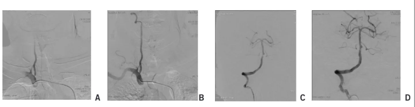 Figure 1 – The stenosis of the vertebral artery and the clinical efficacy. Before surgery, ostial stenosis degree of the vertebral  artery was 85% (A); after surgery, it was 0% (B)