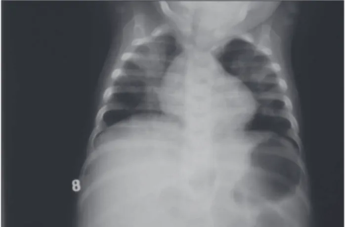 Figure 1 – Chest radiograph showing parenchymal opacities  in apical regions both lungs.
