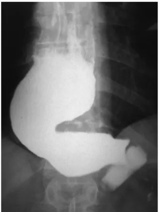 Figura 1 – Dolico megaesôfago e dilatac¸ão do estômago proximal à banda com estase esofagogástrica do contraste.