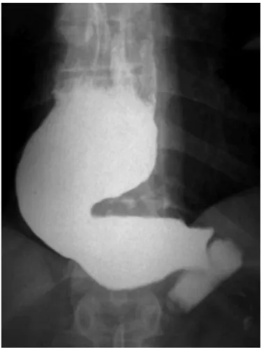 Fig. 2 – Overview showing the band preventing adequate  passage of the contrast to the distal stomach.
