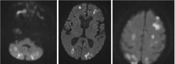 Fig. 1 – Diffusion-weighted image (DWI) showing multiple high signal-intensity lesions in the cerebral hemisphere (mainly watershed areas) and the cerebellar hemisphere.