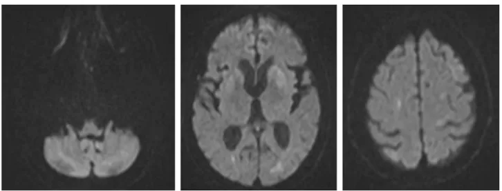 Fig. 3 – MRI of the head on the 15 th day of hospitalization.