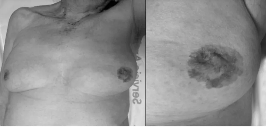 Fig. 1 – Patient presenting erythema and nipple retraction.