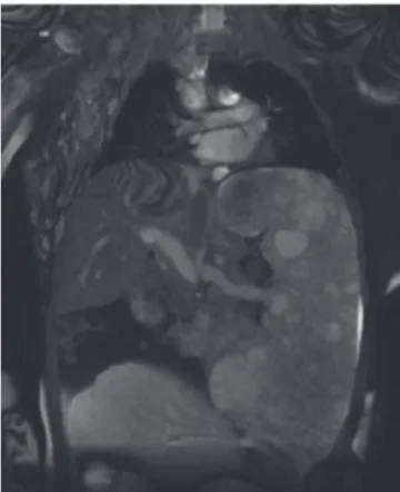 Fig. 1 − Magnetic resonance imaging of lower limbs with  coronal T1‑weighted sequences showing diffuse left leg  enlargement due to extensive proliferation of adipose  tissue associated with atrophy of adjacent muscle groups.