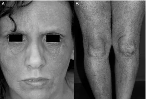 Fig. 1 – Clinical features of AD in adults. A. Facial involvement in atopic dermatitis-extensive lichenification of the front, periorbital areas, and malar regions, sparing the central seborrheic areas