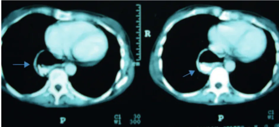 Fig. 2 – Chest computed tomography showing diverticulum with air‑fluid level in posterolateral right side (arrows).
