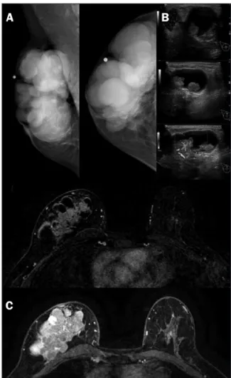 FIGURE 1   Clinical exam. (A) lump in right breast; (B) marked area  showing clinical localization; (C) open biopsy.