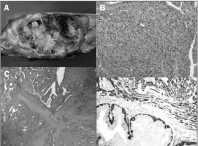 FIGURE 3   Pathologic findings. Macroscopic finding: (A) Gross  examination showed a large solid-cystic tumor
