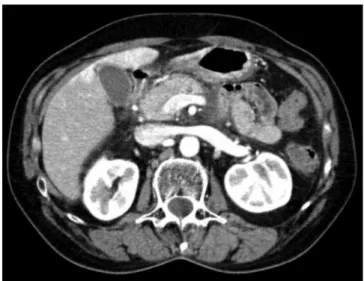 Fig. 1 – Computed tomography image of a patient with  pancreatic dorsal agenesis and acute pancreatitis