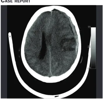 FIGURE 1   Computerized tomography of the cranium showing  acute frontoparietal subdural hematoma to the left with a subjacent  frontoparietal focus of contusion
